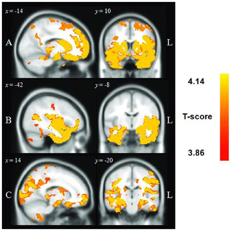 Regions Of Significant Grey Matter Intensity Decrease In Patient Groups