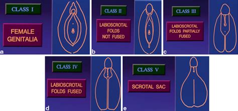 Disorders Of Sex Development Obgyn Key