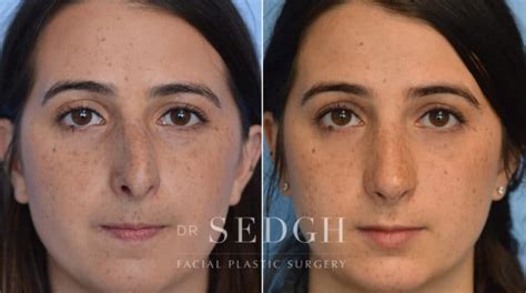 Crooked Nose Surgery Before After Photos Dr Sedgh