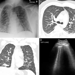 Pulmonary Edema Ultrasound