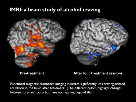 Brain scans confirm less alcohol craving after treatment - UW Medicine ...