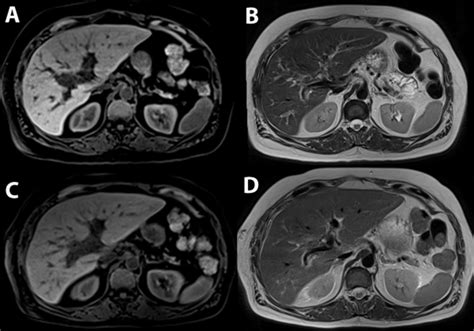 Patient V., 64 years old, Klatskin tumor. A, C -T1WI with fat ...