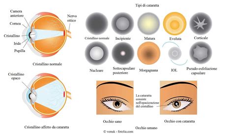 Cataratta All Occhio Congenita O Secondaria Sintomi Intervento