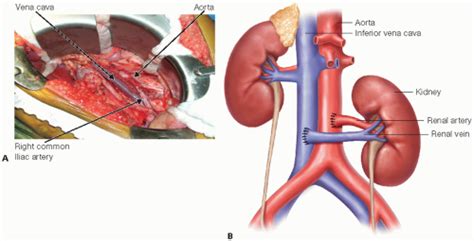 Pediatric Kidney Transplantation | Plastic Surgery Key