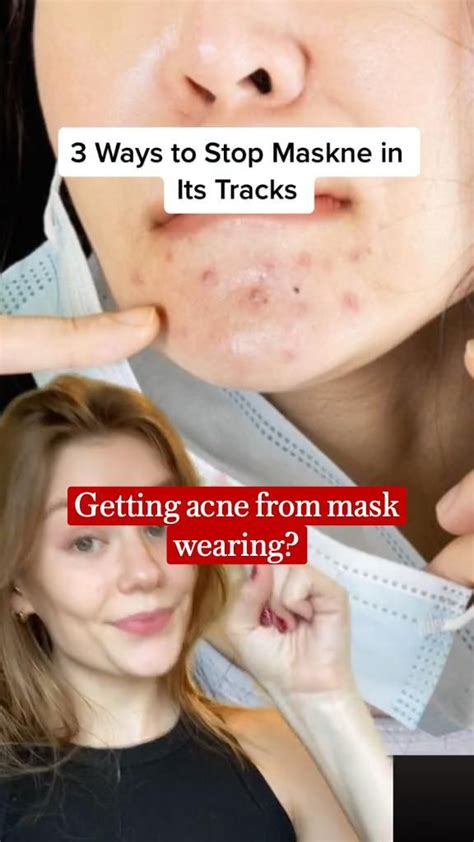 3 Ways To Prevent Acne Breakouts Under Your Mask Acne Treatments And Kits Organic Skin Care