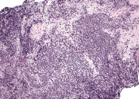 Plasma Cells Vs Lymphocytes