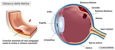 Distacco Della Retina Dr Luca Buzzonetti Medico Chirurgo Oculista Roma