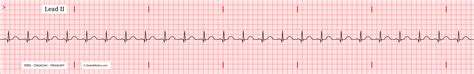 The Normal Sinus Rhythm (NSR) EKG/ECG