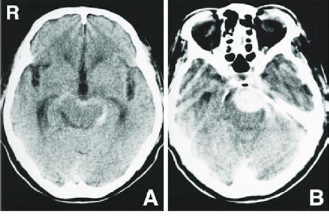 A: Computed tomography (CT) scan showing subarachnoid hemorrhage in the ...