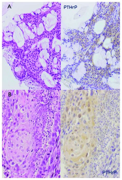 PTHrP Expression In Mucoepidermoid Carcinoma Immunohistochemical