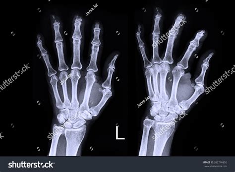 Xray Left Hand Stock Photo 382716850 | Shutterstock