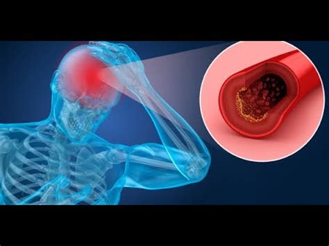 Neglect and other difficulties after stroke with left hemiparesis ...