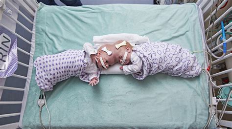 Formerly Conjoined Twins Erin And Abby Delaney Thriving Months After Separation Surgery At