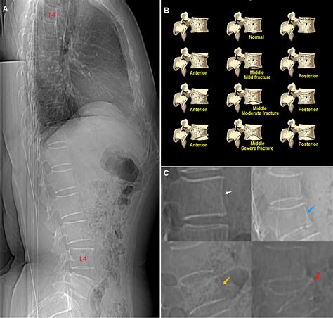 Frontiers Differences In Spine Volumetric Bone Mineral Density