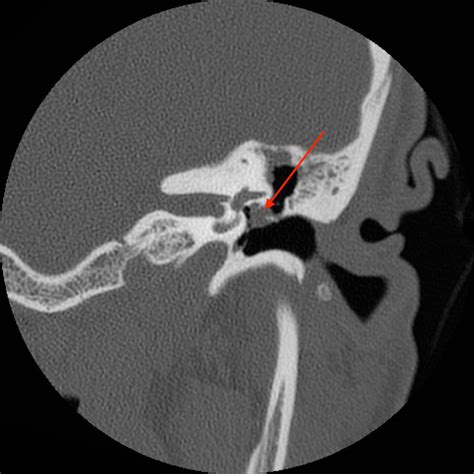 Cholesteatoma — Chad Ruffin Md