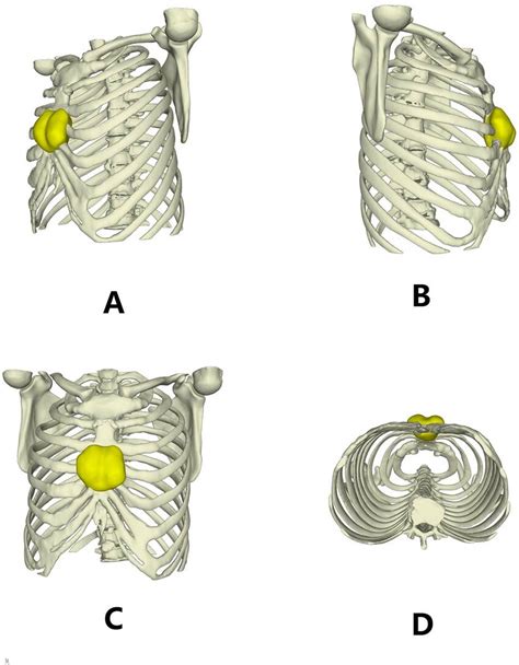 Three dimensional reconstruction images of the chest wall. | Download Scientific Diagram