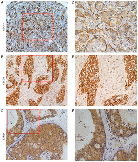 Positive Expression Of Abca Abcg And Lxr In Tnbc Tissues Detected