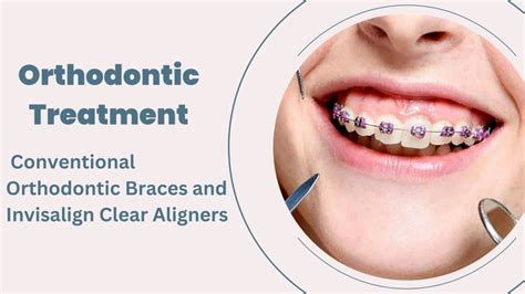 Orthodontic Treatment Conventional Orthodontic Braces And Invisalign Clear Aligners Arya