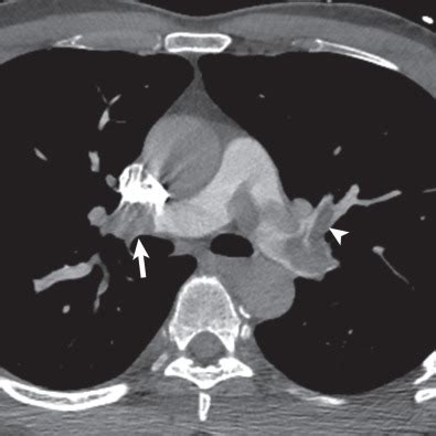 Acute Pulmonary Embolism Radiology Key