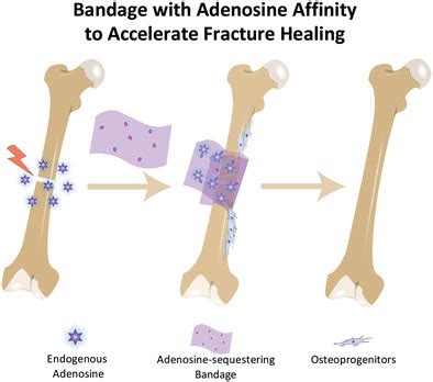 In Vivo Sequestration Of Innate Small Molecules To Promote Bone Healing