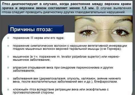 Птоз верхнего века: причины, классификация, диагностика, лечение