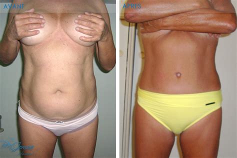 Portfolio Abdominoplastie Dr Ben Jemaa