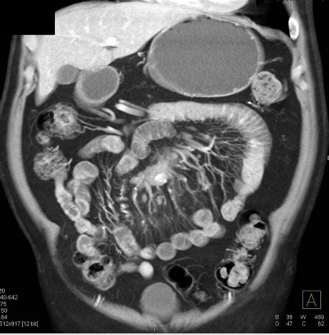 Carcinoid Tumor Root Of Mesentery With Desmoplastic Reaction Small