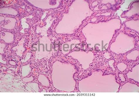 Endemic Goiter Light Micrograph Abnormal Enlargement Stock Photo