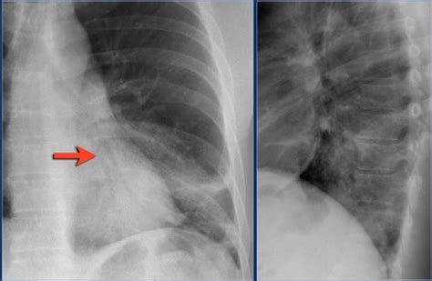 Lobar Pneumonia Chest X Ray