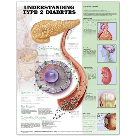 Understanding Type 2 Diabetes Anatomical Chart 9781587799556 Medicine And Health Science Books