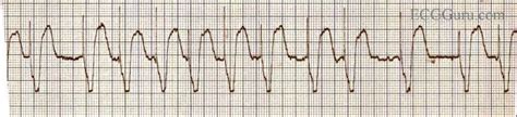 Pacemaker Mediated Tachycardia Ecg Guru Instructor Resources