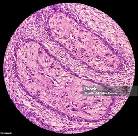 Microscopic Tissue Of Retromolar Region Show Buccal Mucosa Squamous