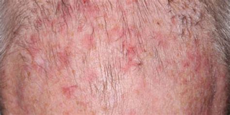 Actinic Keratosis Arlington Skin Doctor