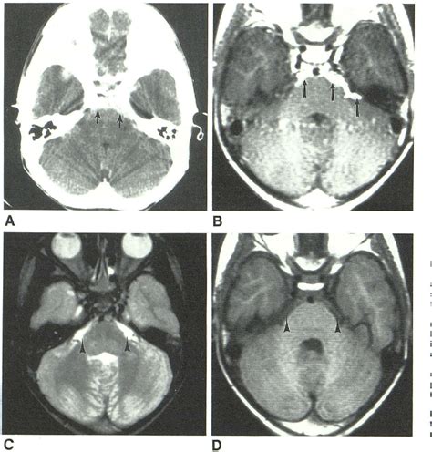 Figure 1 From Gd DTPA Enhanced MR Imaging Of Leptomeningeal Spread Of