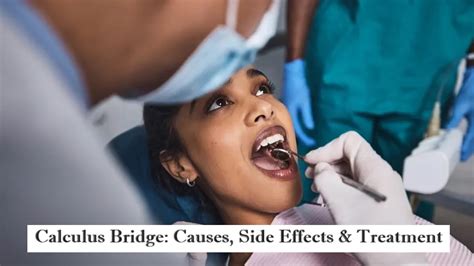 Calculus Bridge: Causes, Side Effects & Treatment - MagazineWebPro