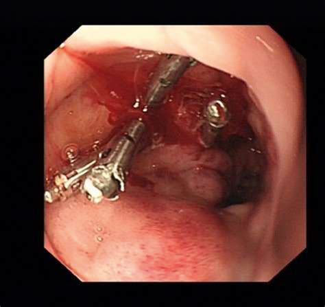 Acute Upper Gastrointestinal Haemorrhage Medicine