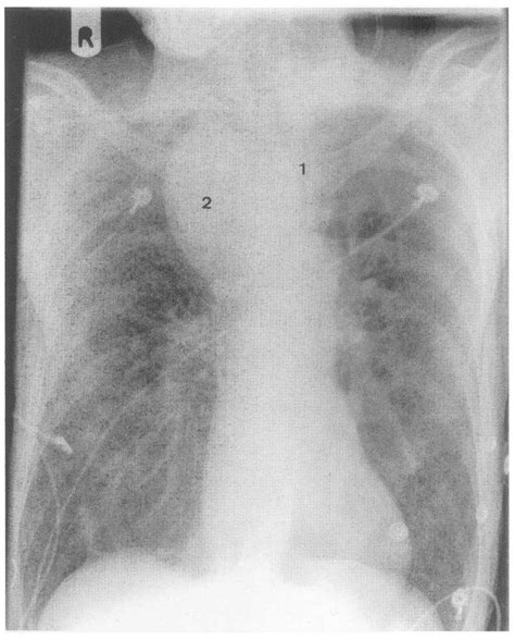 Chest Roentgenogram Of Case Mass Next To The Right Upper Mediastinum