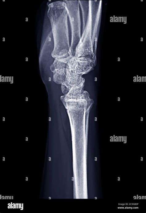 X Ray Image Of Right Wrist Joint Lateral View For Diagnosis Rheumatoid