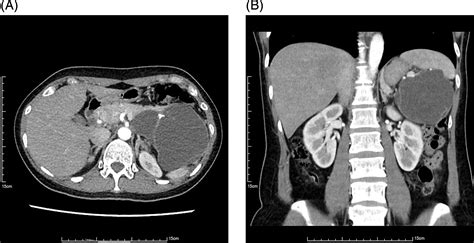 Challenge In Differentiation Of Pancreatic Cystic Neoplasms Between