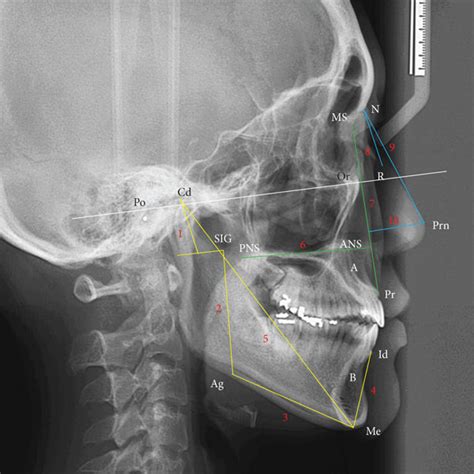 Cephalometric Landmarks And Linear Measurements N Nasion Or