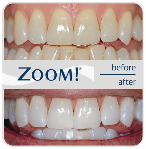 Zoom! Teeth Whitening - Prices, Costs, Information - Dental Clinics