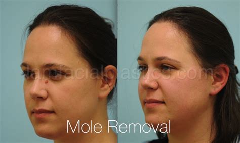 Mole Removal Dallas, Plastic Surgery Procedures Plano, TX