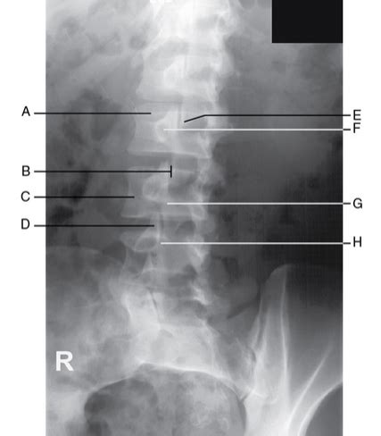 Oblique Lumbar Vertebrae Rpo Radiograph Diagram Quizlet