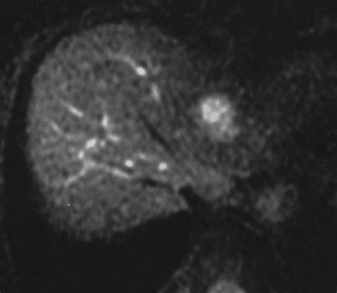 Single Breath Hold T2 Weighted MR Imaging Of The Liver Value Of Single