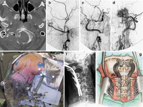 Postoperative Ct Scan Of The Same Patient Shown In Fig Reveals A