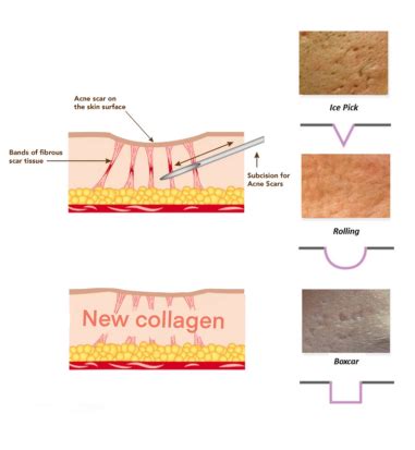 Subscision For Acne Scarring Harmony Medical Aesthetics Cosmetic