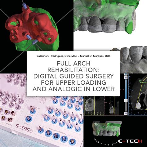 Full Arch A Carico Immediato Chirurgia Guidata Per Il Superiore E