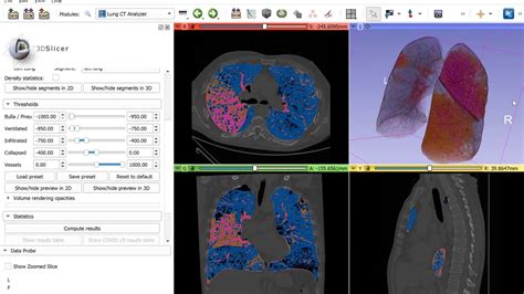 Automated Lung CT Segmentation And Analysis For COVID 19 Assessment