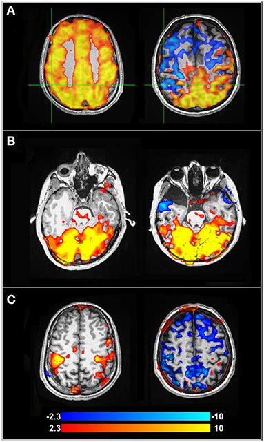 Frontiers The Relationship Between Cognition And Cerebrovascular