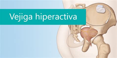 Overactive Bladder Vejiga Hiperactiva Pi Es